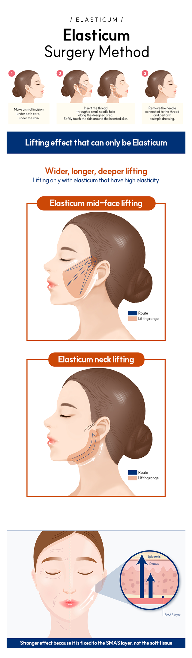 Elasticum Surgery Method - 1. Make a small incision under both ears, under th chin. 2. Insert the thread through a small needle hole along the designed area. softly touch the skin around the inserted skin. 3. Remove the needle connected to the thread and perform a simple dressing.